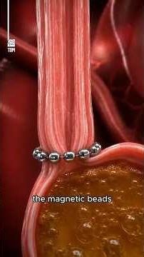 Why Doctors Use this Ring for Acid Reflux