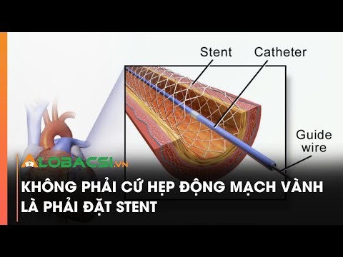 Không phải cứ hẹp động mạch vành là phải đặt stent | Video AloBacsi