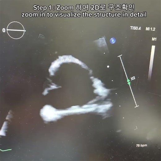 Echo tips you should know : 심장초음파 기본tip : Zoom → 2D → Color 