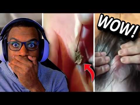 Extreme Pimple Compilation Nobody Was Ready For