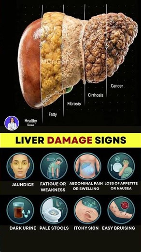 8 Early Signs of Liver Damage You Should Never Ignore | Liver Damage