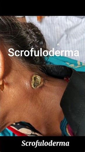 #scrofuloderma #tuberculosis #infectious_disease