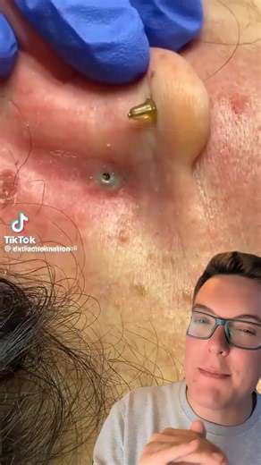 GREATEST EVER BLACKHEAD REMOVAL - Laser Blackhead Extraction #shorts