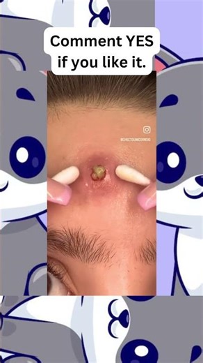 🔥Deep Blackheads, Milia & Whitehead Removal pimple popping New| Big Cystic Acne Extraction