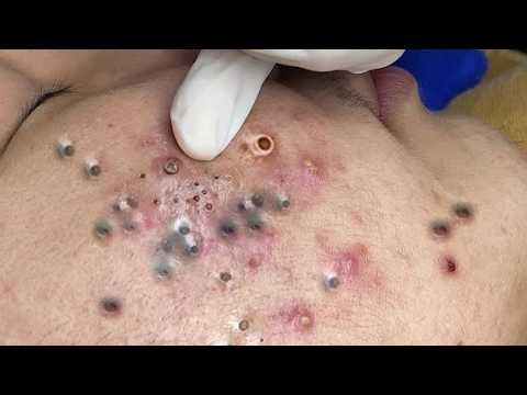 Sac dep spa new videos today 2027 blackheads #relaxing #Asmr #acne #Asmrbyasghar