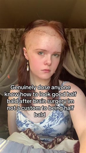Tips to Look Confident with Half Bald After Surgery