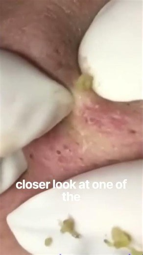 #blackheads #blackheadremoval #blackheadextraction #skincare#cloggedpores#pores#youtubeshorts#shorts