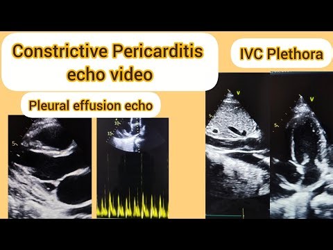 Constrictive Pericarditis echo video#Pleural Effusion echo video