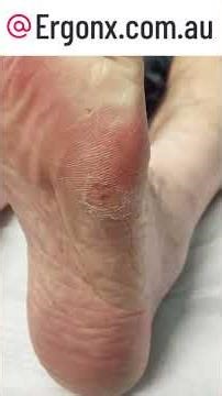 Ultimate Foot Relief Corn Removal by Podiatrist with Scalpel Step-by-Step #FootCare #Podiatry