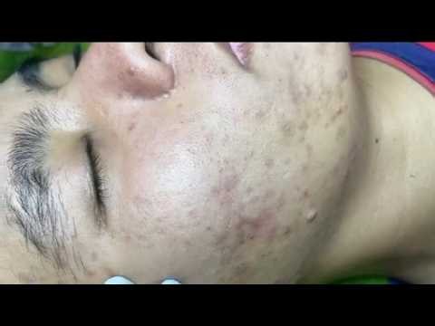 Acne Facial Treatment Ka Real Result 😱 | Sac Dep Spa Care