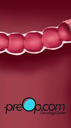 PreOp® Colonoscopy Lower Endoscopy*