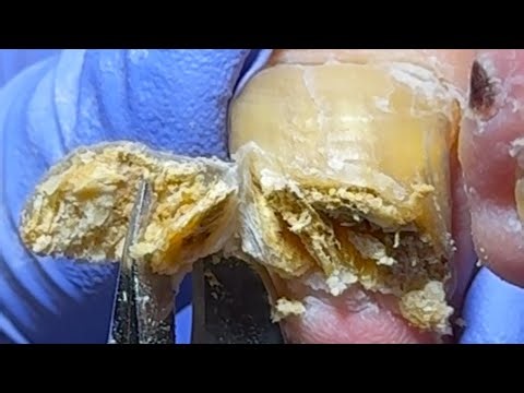 Onychomycosis Is Super Thick, Pedicure Is Very Effective【Xue Yidao】