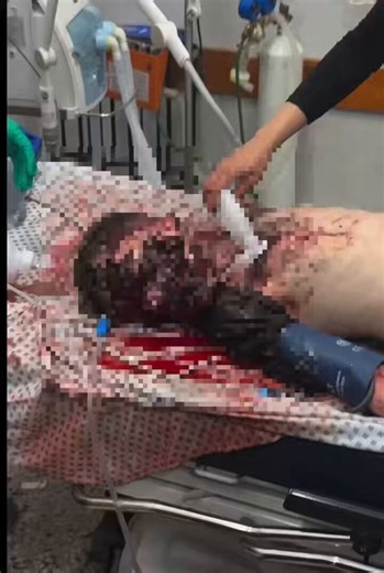 ⚠️Sensitive Content ⚠️🚨BREAKING: A 10 year old Palestinian child is fighting for his life after surviving an Israeli airstrike that killed his father in Gaza, He suffered severe facial injuries and a critical brain injury.Documented by Dr. Jamal Salha - Gaza
