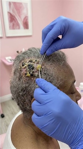 Close-Up Scalp Treatment for Skin Bumps and Blemishes