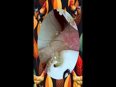 Blackheads Removal | Acne Treatment and Very Satisfying Satisfying Pimple pop #blackheads