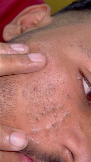 Deep Cleaning ASMR ✨new Elderly face Care | Asghar Barber Shop | sac be spa blackheads care #4000