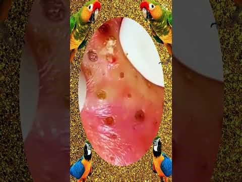 Blackheads Removal #348 | Acne Treatment and Very Satisfying Satisfying Pimple pop #blackheads