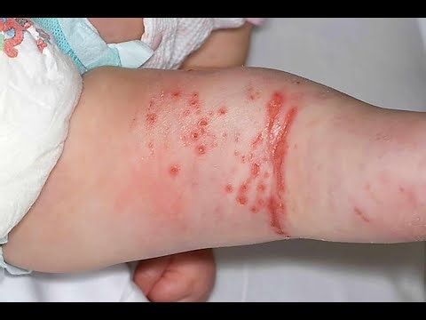 Common skin conditions in the newborns or Neonates