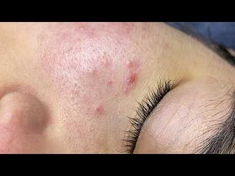 Extracting acne for a handsome guy. | Sac Dep Spa Treatment Official