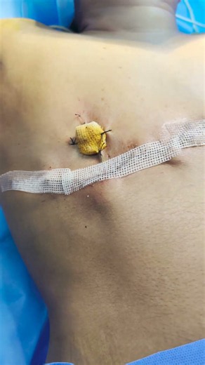 FTM Double Insicion surgery result