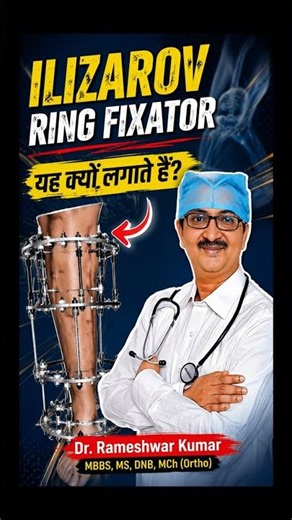 इलिजारो रिंग फिक्सेटर क्या है? हड्डी न जुड़ने और इंफेक्शन का असरदार इलाज | Ilizarov Ring Fixator Exp