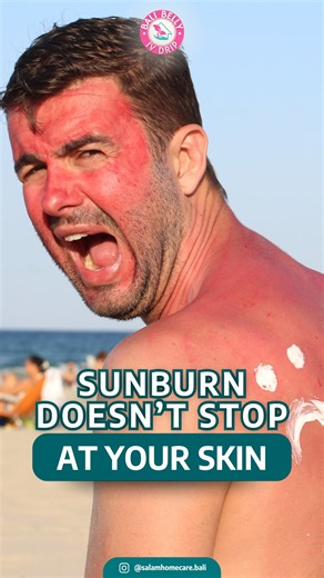 IV Drip Bali | Bali Belly Treatment on Instagram: "Sunburn doesn’t stop at your skin. Prolonged sun exposure can lead to dehydration, oxidative stress, and a weakened immune system — not just redness on the surface. While sunscreen protects your skin, your body also needs support from within. ✨ Rehydrate ✨ Restore essential vitamins ✨ Support recovery after sun exposure With Bali Belly IV Drip by Salam Homecare, we help your body recover faster, safely, and comfortably — right where you are. 📩 