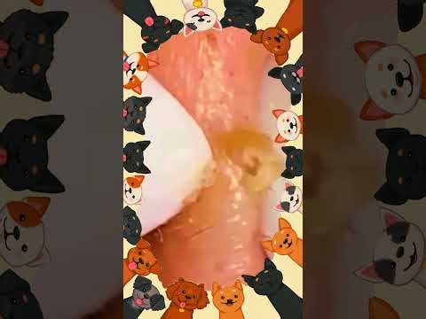 Blackheads Removal | Acne Treatment and Very Satisfying Satisfying Pimple pop #blackheads