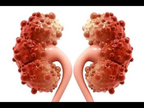 Cyst infection in Kidney; recognized complication of cystic kidney diseases