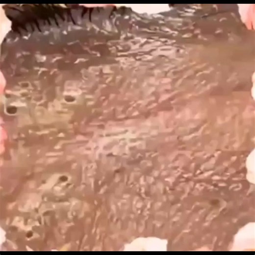 Deep blackheads pimple Popper on skin!3 Say YES and watch video 😍😍😍 #blackhead #ti̇ktok #skincare