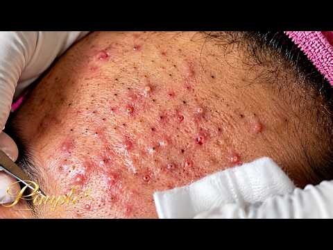 Extreme Blackhead Removal and Pimple Popping Compilation #ep2