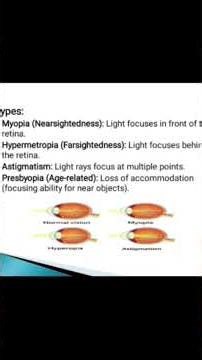 Refractive Error lecture Hindi/Urdu #refractiveerrors #myopia #hypermetropia #astigmatism
