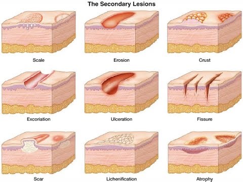 Crusts, Scales, Excoriations, Lichenification, Ulcer, Scars, Erosions, Fissure Skin conditions