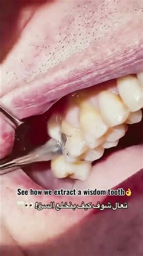 How a Dentist Performs a Tooth Extraction 🦷 | Oral Surgery