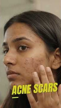 Clear Acne Scars & Open Pores With Zero Downtime! #Shorts