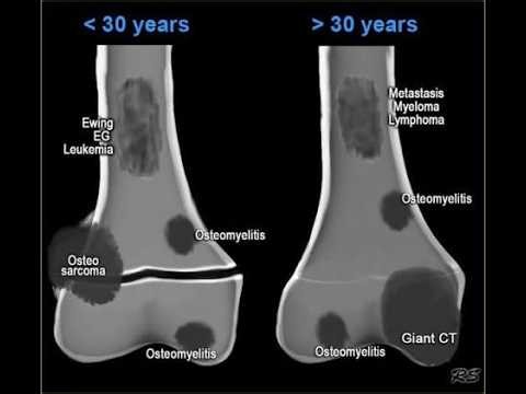 Osteolytic And osteogenic Metastatic lesions; patterns of bone involvement seen in cancer spread