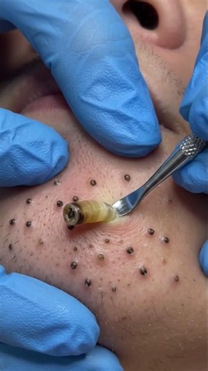 Long Blackhead Extraction ASMR | Giant Sebum Plug & Multiple Blackheads Removed