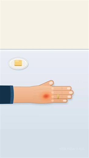 Minor Burn? Start With Cool Water Butter, toothpaste and oil don't belong on a burn. This video shares Mayo Clinic's first aid advice for small, minor burns: cool running water for about 10 minutes, removing rings or tight items before swelling starts, and knowing when to get emergency care. #BurnFirstAid #MinorBurns #BurnCare #FirstAid #BurnSafety