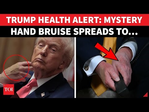 On Cam: Trump INJURED, Mystery Bruise 'Spreads' As Health Panic Rocks America | 'HOLE IN HAND...'