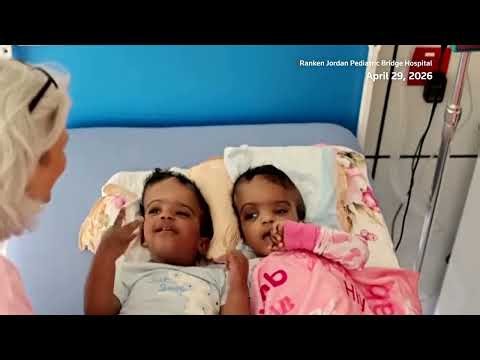 Missouri doctors successfully separate twins joined at the head