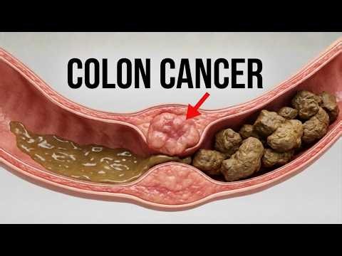 Colon Cancer Warning Signs I Shouldn't Have Ignored
