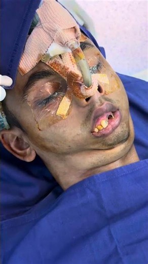 Patient with Bird -face deformity and zero mouth opening
