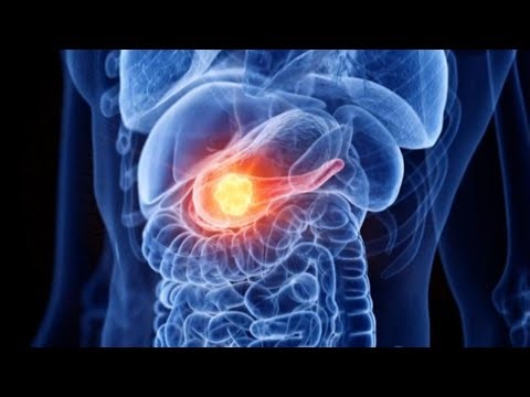 High hopes for new pancreatic cancer therapies