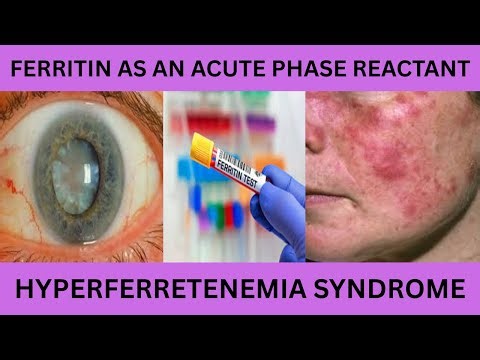 FERRITIN AS AN ACUTE PHASE REACTANT.HYPERFERRETENEMIA.HIGH FERRITIN AND INFLAMMATION,