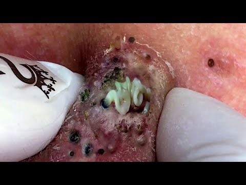 Satisfying Blackhead Removal – Deep Acne Cleaning for Ultimate Relaxation - 293434