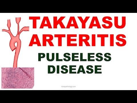Takayasu Arteritis Explained | Pulseless Disease | Vasculitis - Part 3