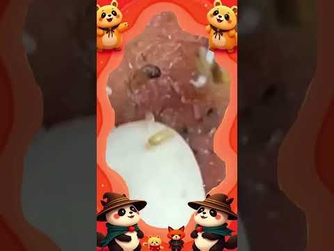 Satisfying self-cleaning of blackheads Acne Treatment Pimple pop