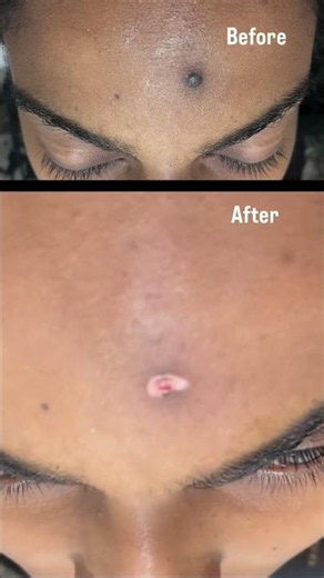 Laser mole removal