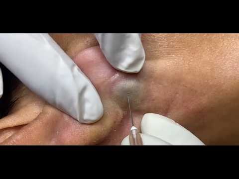 Big Blackhead Removal! | blackheads behind ears | blackhead popping