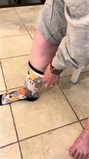Are Compression Socks Hard to Put On What Actually Helps