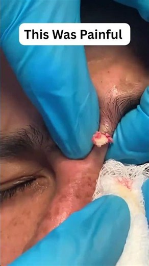 Quick pimple Explosion